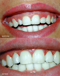 Gingivectomy