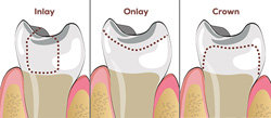 Inlays, Onlays & Crowns