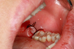Surgical Extractions