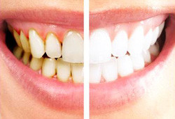 Tooth Scaling