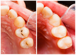 Tooth Fillings