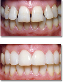 Veneers